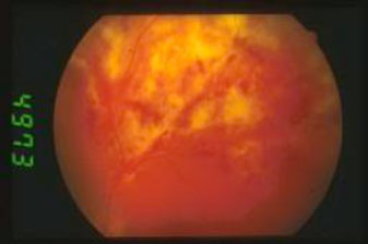 Retinite-da-CMV 01