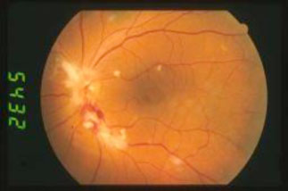 Retinite-da-CMV 04