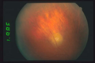 Retinocoroidite-da-Toxoplasma