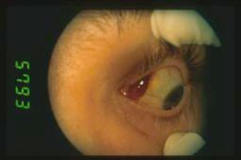 Sarcoma-di-Kaposi 02