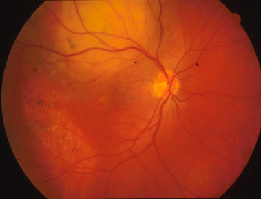 il-melanoma-uveale 02