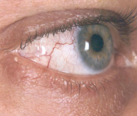 melanoma-congiuntivale 04