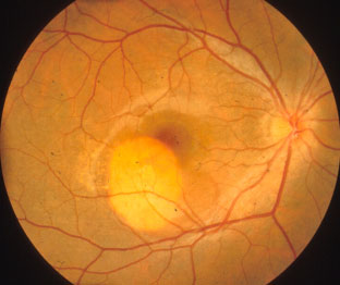 osteoma-della-coroide